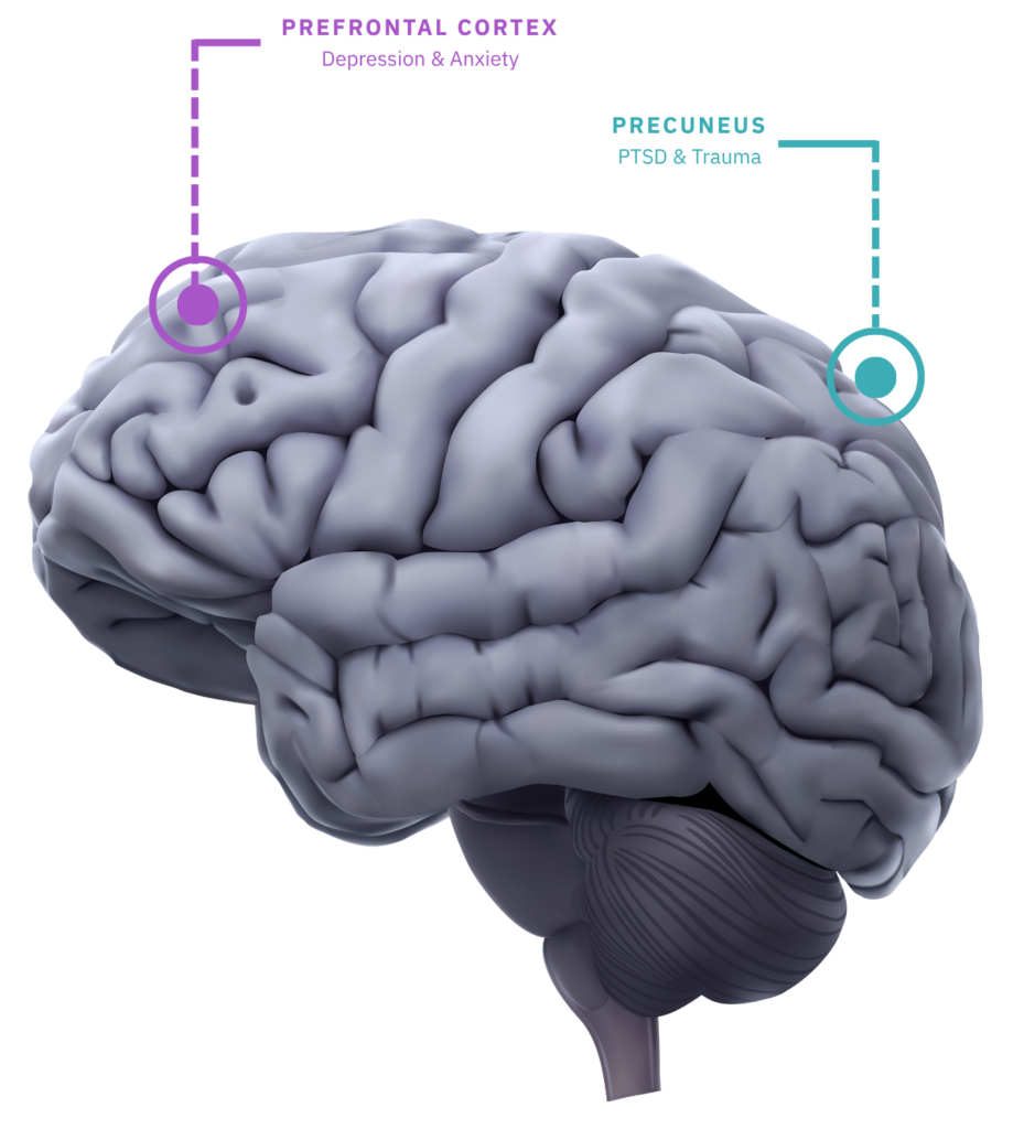 reduced-tms-therapy